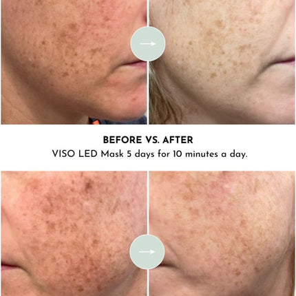 VISO - FDA Certified Red Light Therapy Mask